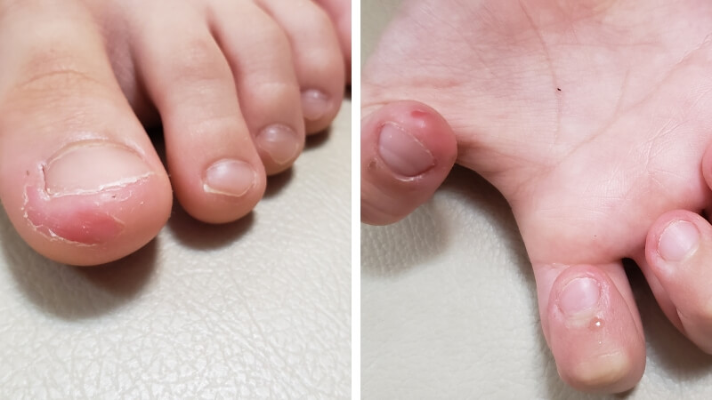 5歳息子の爪噛みがひどい画像